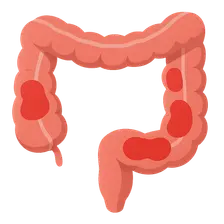 Inflammatory bowel disease