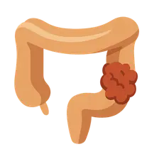 Colorectal cancer