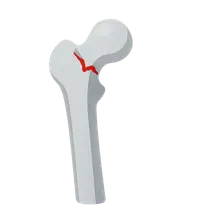 Neck of femur fracture