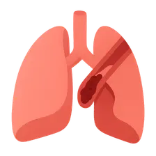 Pulmonary embolism
