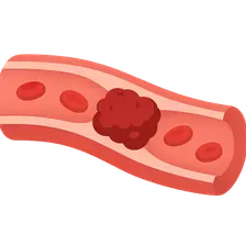 Venous thromboembolism
