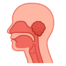 Nasopharyngeal Carcinoma