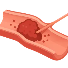 Thrombolysis and Thrombectomy