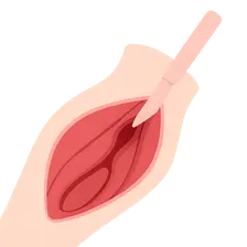 Compartment syndrome diagnosis and fasciotomy