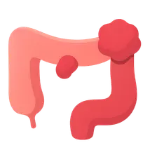 Colon polyps and neoplasms