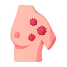 Hereditary breast cancer syndromes