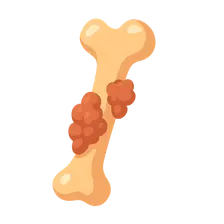 Metastatic Bone Disease