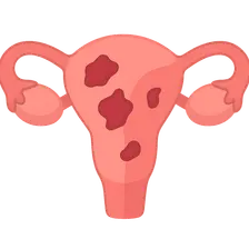 Endometriosis-Associated Pain