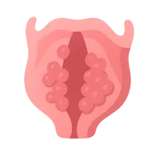 Laryngeal Papillomatosis