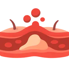 Acute Inflammation: Vascular Events