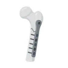 Biomechanics of Fracture Fixation