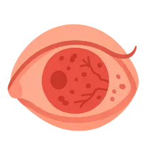Diabetes Mellitus