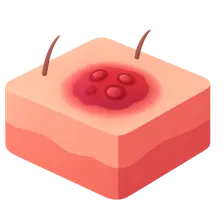 Soft Tissue Infections