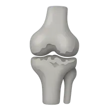 Osteoarthritis