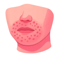 Perioral Dermatitis