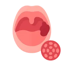 Oropharyngeal Cancer and HPV