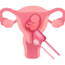 Cervical cancer screening in pregnancy
