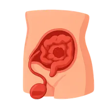 Hyperthermic Intraperitoneal Chemotherapy