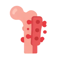 Implant-Related Infections