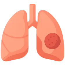 Pulmonary Neoplasms