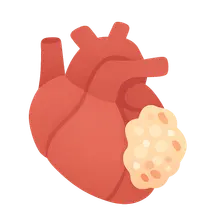 Biofilms in endocarditis