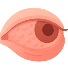 Conjunctivitis: Chronic