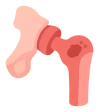 Infected Arthroplasty Management