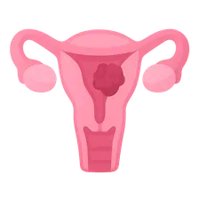 Endometrial Cancer