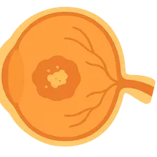 Age-Related Macular Degeneration