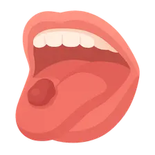 Oral Cavity Cancer