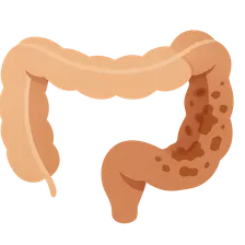 Necrotizing Enterocolitis