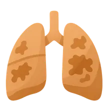 Idiopathic pulmonary fibrosis