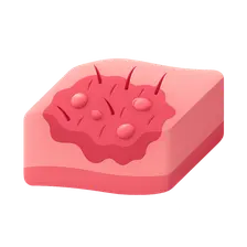 Atopic Dermatitis