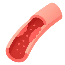 Vasculitis