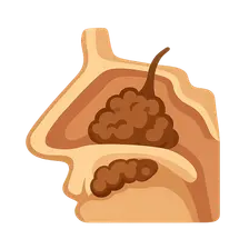 Allergic Fungal Sinusitis