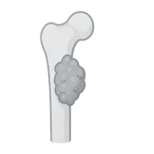 Tumor-Like Lesions of Bone