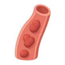 Antiphospholipid Syndrome