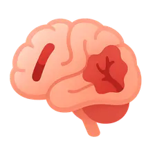 Ischemic vs hemorrhagic stroke differentiation