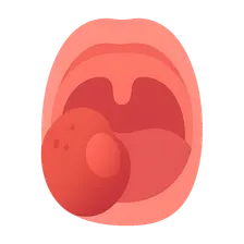 Peritonsillar Abscess