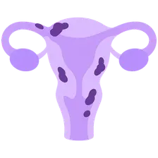 Endometriosis