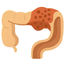 Necrotizing Enterocolitis