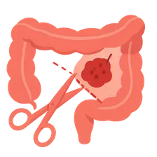 Colorectal cancer resection principles