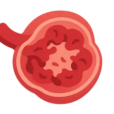 Rapidly progressive glomerulonephritis