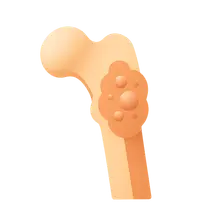 Bone Tumors and Tumor-like Lesions