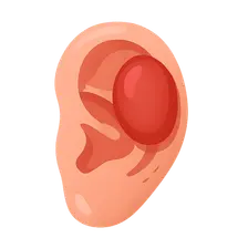 Auricular Hematoma