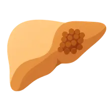GSD type III (Cori disease)