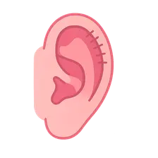 Otoplasty