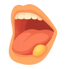Sialolithiasis