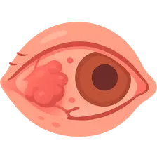 Infectious Scleritis