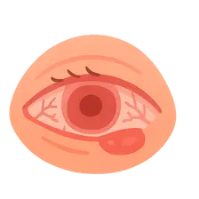 Conjunctivitis: Allergic